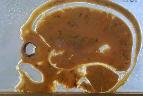 Une coupe cranio-enc�phalique | AFP/JOEL SAGET